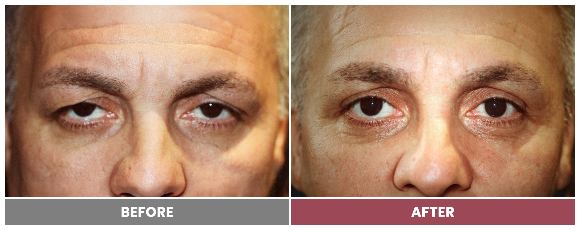 Upper Blepharoplasty - Case 49
